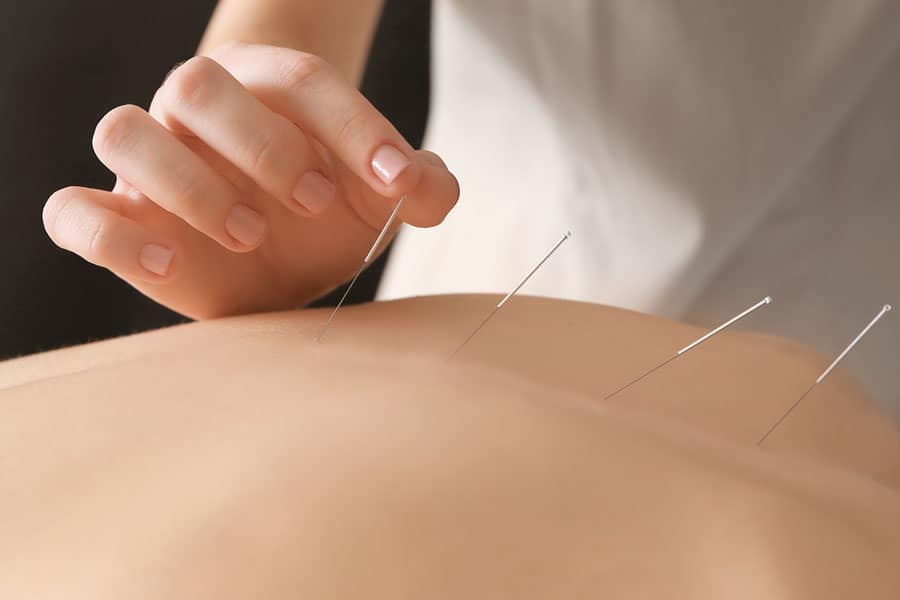 bigstock-Young-woman-undergoing-acupunc-186668650 bigstock-Young-woman-undergoing-acupunc-186668650